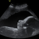 4D Sprouts 3D 4D HD Ultrasound Sarasota Florida-17