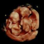 TWINS 15w 4d_2-Edit